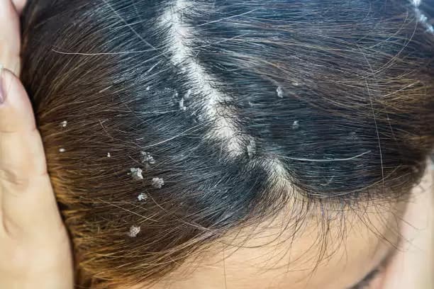 5 Bahan Alami yang Bisa Hilangkan Ketombe