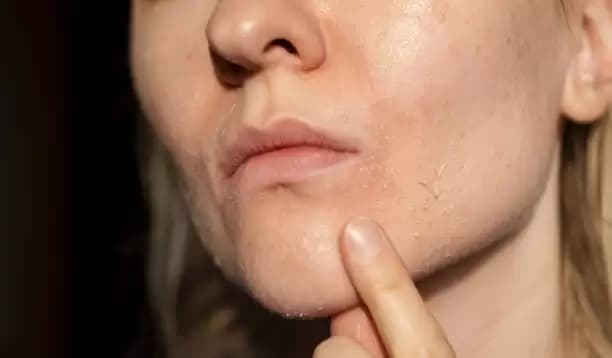Tips Atasi Jerawat dan Bibir Kering Saat Berpuasa