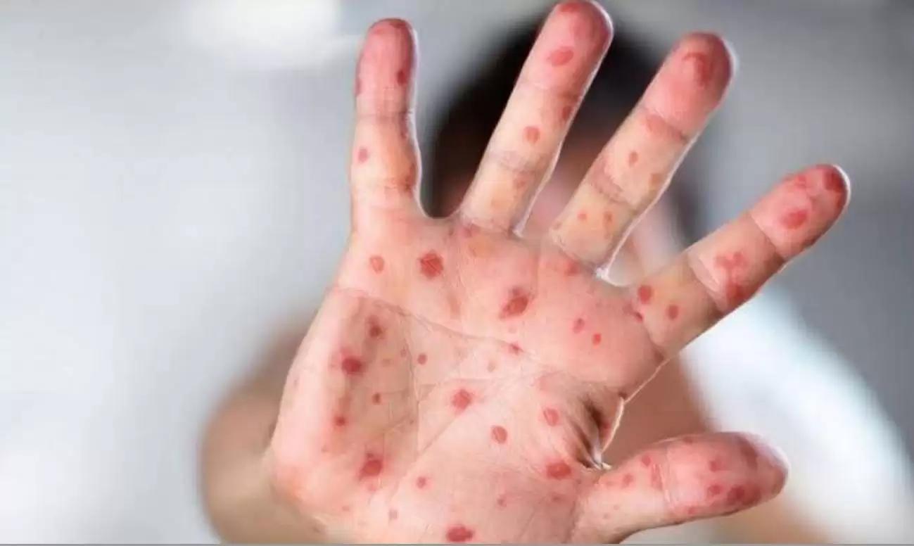 Hindari Virus Cacar Monyet, Dinkes Imbau PHBS di Masyarakat