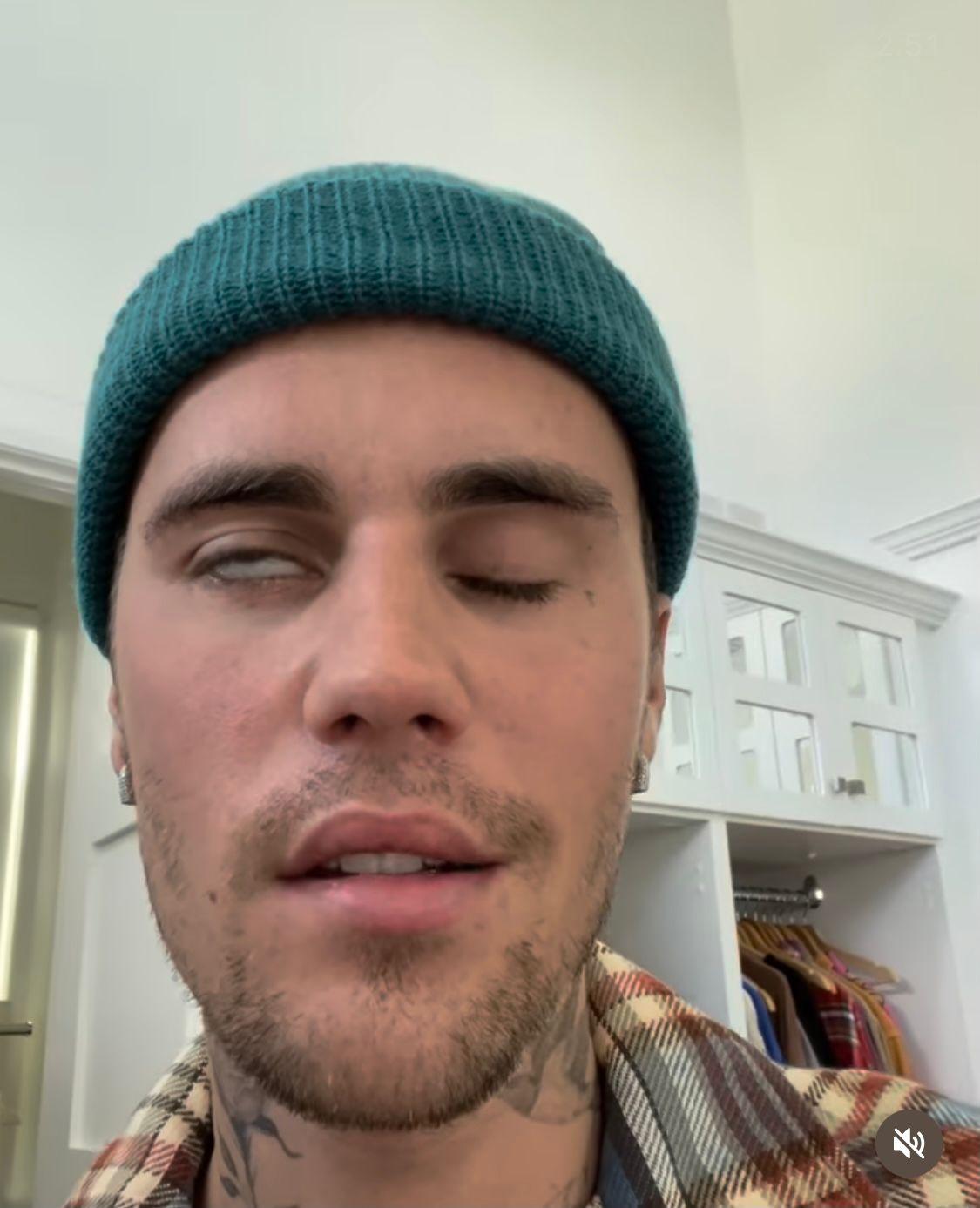 Justin Bieber Mengalami Virus yang Menyebabkan Sebagian Wajahnya Lumpuh