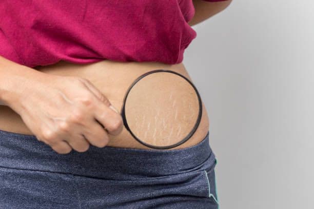 Jangan Khawatir! Berikut Tips Memudarkan Stretch Mark Secara Alami