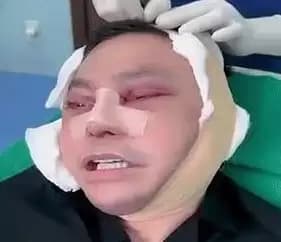 Hidung dan lingkar wajahnya tampak dibalut perban. Mata bagian atas juga seperti dijahit (Foto: Dok MI/kaltengpedia)