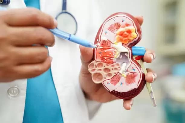 Kelebihan Konsumsi Garam Bisa Picu Penyakit Ginjal Kronis