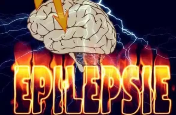 Foto Ilustrasi -Epilepsi