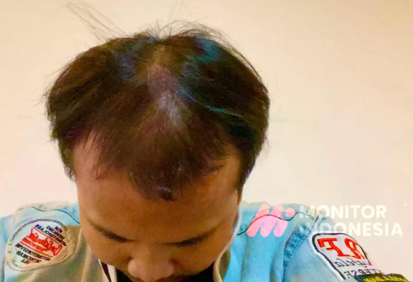 Foto Rambut Rontok