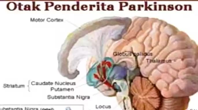 Ilustrasi - Otak penderita penyakit parkinson