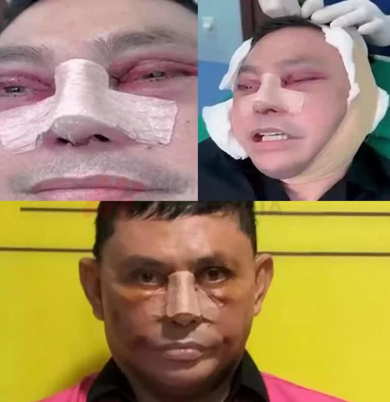 Penampakan Muka DPO Ujang Iskandar Pascaoperasi Plastik di Vietnam - Anak Buah Surya Paloh yang Ditangkap Kejagung!